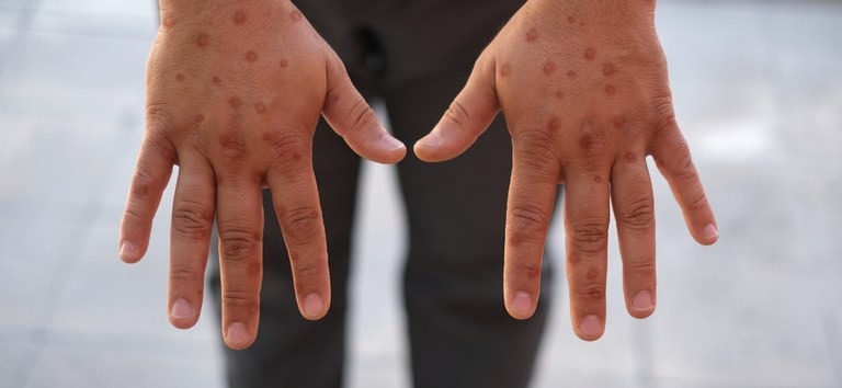 Caso de Mpox é confirmado durante o Carnaval no Brasil