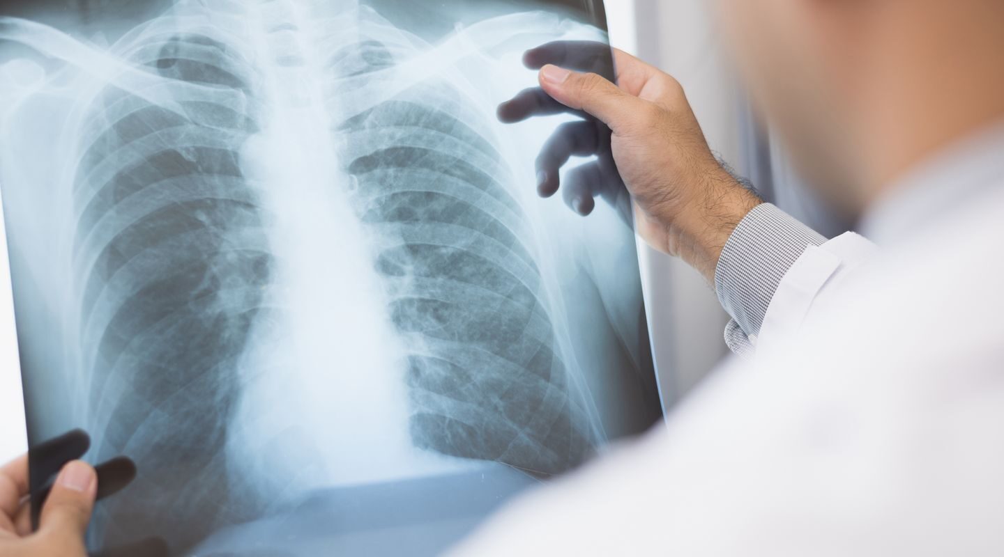 Anvisa aprova novo medicamento para câncer de pulmão avançado